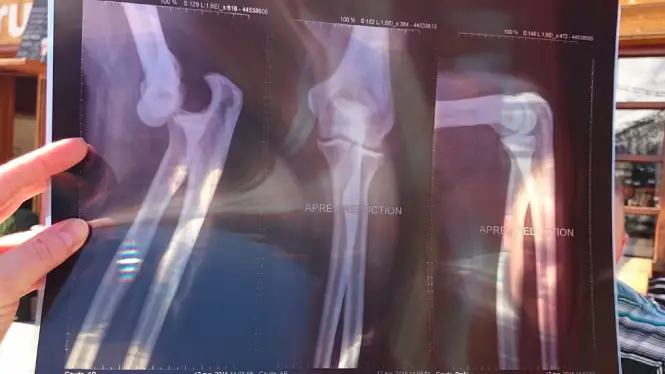 Image of a dislocated elbow following an accident during a ski season